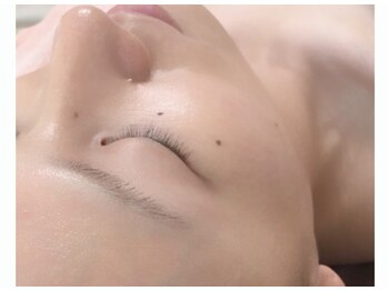 アップル マリー 江別/■糸脱毛