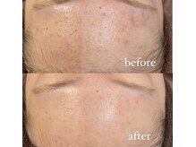 レシェルサロン(Lechelle Salon)/ハーブピーリング