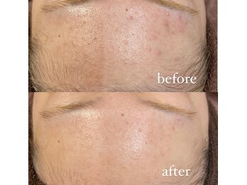 レシェルサロン(Lechelle Salon)/ハーブピーリング