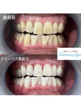 ホワイトニングサロン 熊本店/お手軽セルフホワイトニング