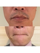 カリスティ(CHARIS.T)/ヒゲ脱毛/8回目