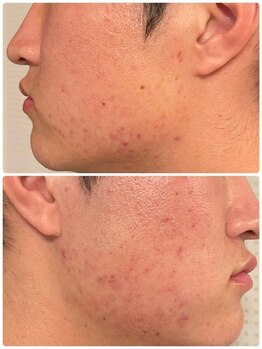 ケーフリー(K-free)/ハーブピーリング