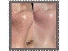 長崎初上陸韓国式3D毛穴洗浄で頑固な毛穴汚れもスッキリ♪