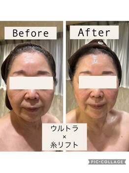 サロン ド スー(Salon de Suu)/貼る!糸美容でたるみ改善!