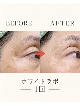 イゴ(IGO)の写真/ホワイトラボで長年のシミにアプローチ。魔法のシミケアで自信溢れる素肌へ♪