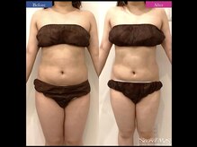 イヨヨ(iyoyo)/BeforeAfter　施術３回