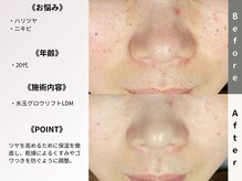 ルディラ 池袋店/水玉グロウリフト(韓国式LDM)