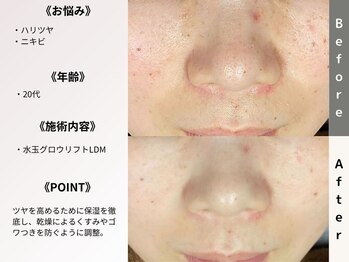 ルディラ 池袋店/水玉グロウリフト(韓国式LDM)