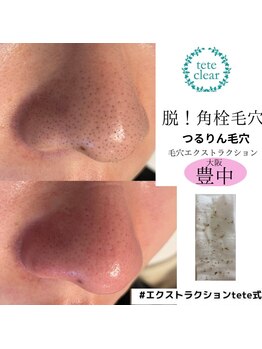 プリュネル(Prunelle)/毛穴エクストラクション