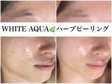 アワピール 天王寺店(AWA PEELL)/ハーブピーリング/ニキビケア