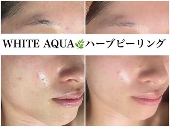 アワピール 天王寺店(AWA PEELL)/ハーブピーリング/ニキビケア