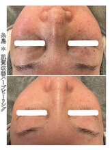 エヌプラス(N+)/50代女性＊ピーリング2回後