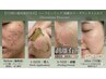 ［7日間の徹底肌質改善］ハーブピーリング/毛穴/ニキビケア¥22000→¥12000
