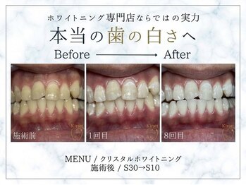 キラット 横浜店(Kiratt)の写真/【最短で白く!】イベント前や急ぎの方におすすめの短期集中コースで、確実に結果を実感いただけます☆