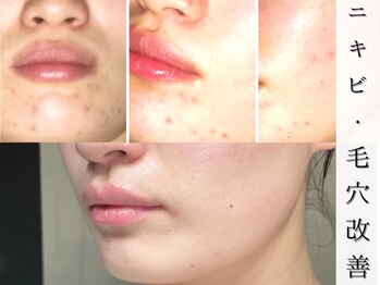 ジョンミー(JONMEE)の写真/【肌質改善】ダクトピール×毛穴洗浄！繰り返す大人ニキビ・黒ずみ・毛穴の悩みを徹底的に根本ケア!