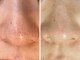 サロンドエルサ(Salon de ELSA)の写真/肌荒れ知らずの、澄みわたる肌へ。本格整えるハーブピーリング！毛穴ニキビをなくして透明感のある肌に