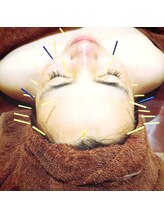 ココビ 駅家店(COCO美)/美容鍼