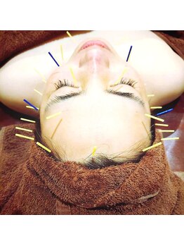 ココビ 駅家店(COCO美)/美容鍼