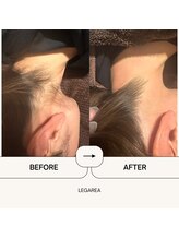 レガリア(LEGAREA)/うなじ脱毛
