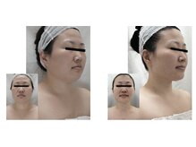 ジョアン(Johan)/新感覚★小顔美人へ大変身♪