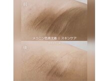 エアリアル 玉名店/脇の黒ずみ改善！黒ずみケア