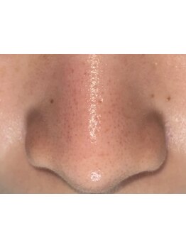 毛穴ケアをしたい