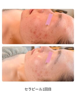 エテル(eter)/セラピール1回目