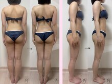 プラスワンビューティテン 新大阪店(Plus One Beauty)/ボディ/ハイパーナイフ/痩身