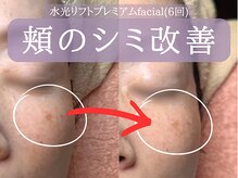 ミトラ(MITRA)