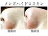 【メンズ/いちご鼻・肌質改善】Men'sハイドロスキン ￥9,900→¥5,500