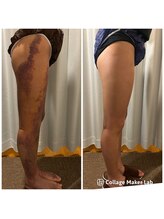 アヌヘア(Anuhea)/京都で1番のインディバ術ケア