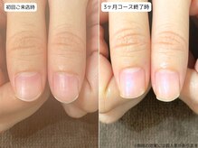 カピリナ(Ka Pilina)/自爪育成・深爪・川崎