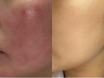 リナート(Rinato)/REVI陶肌ハーブピーリング