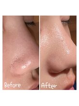 サロンドビオ(Salon de vio)/毛穴洗浄