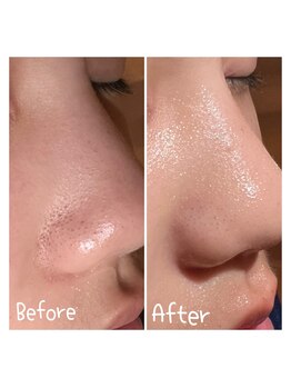 サロンドビオ(Salon de vio)/毛穴洗浄