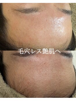 モンクラッシー(Mon classy)/産毛除去ですっぴん潤艶肌