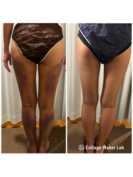 アヌヘア(Anuhea)/京都で1番のインディバ術ケア