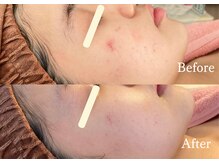 綺麗サロン 脱毛アンドフェイシャル ジュエル(Jewel)/【4BミネラルクリアTR】