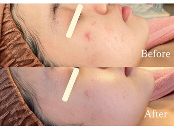 綺麗サロン 脱毛アンドフェイシャル ジュエル(Jewel)/【4BミネラルクリアTR】