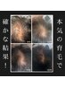 【改善実績多数有り】医療提携だから生える！本気の育毛促進ケア☆￥55,000→