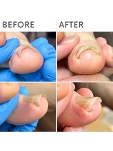 クオッカ(Quokka)/巻き爪ケア