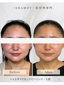 シャムリー(SHAMRY)/VVSダイヤモンドピーリング