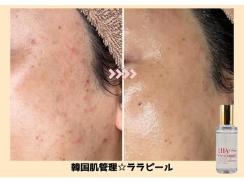 バベルトータルビューティー 北堀江店(Babel Total Beauty)/第4世代【ララピール】