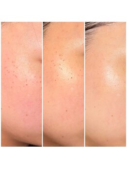 ネシア(nesia)/プラズマシミケア