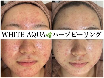 アワピール 天王寺店(AWA PEELL)/ハーブピーリング/ニキビケア