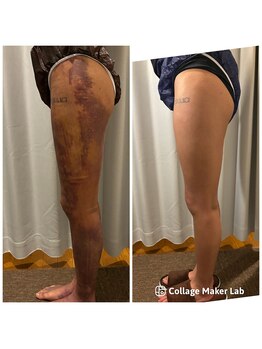 アヌヘア(Anuhea)/京都で1番のインディバ術ケア