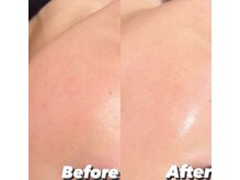 リンダ 西宮店(LINDA)/プラズマシャワー