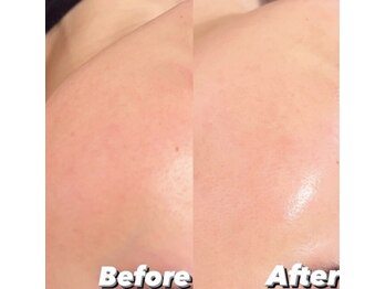 リンダ 西宮店(LINDA)/プラズマシャワー