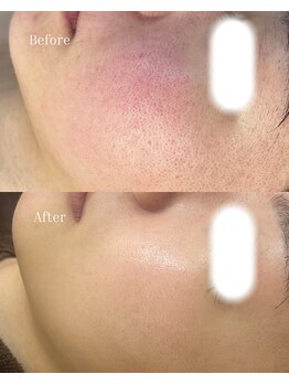 ベリスユイット(BELLIS HUIT)/【毛穴吸引×ハーブピーリング】