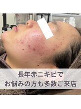 ニキビケア研究所 池袋店/長年赤ニキビでお悩みの方へ！
